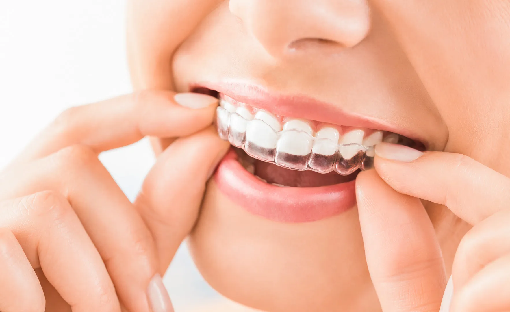 Invisalign in Prairieville