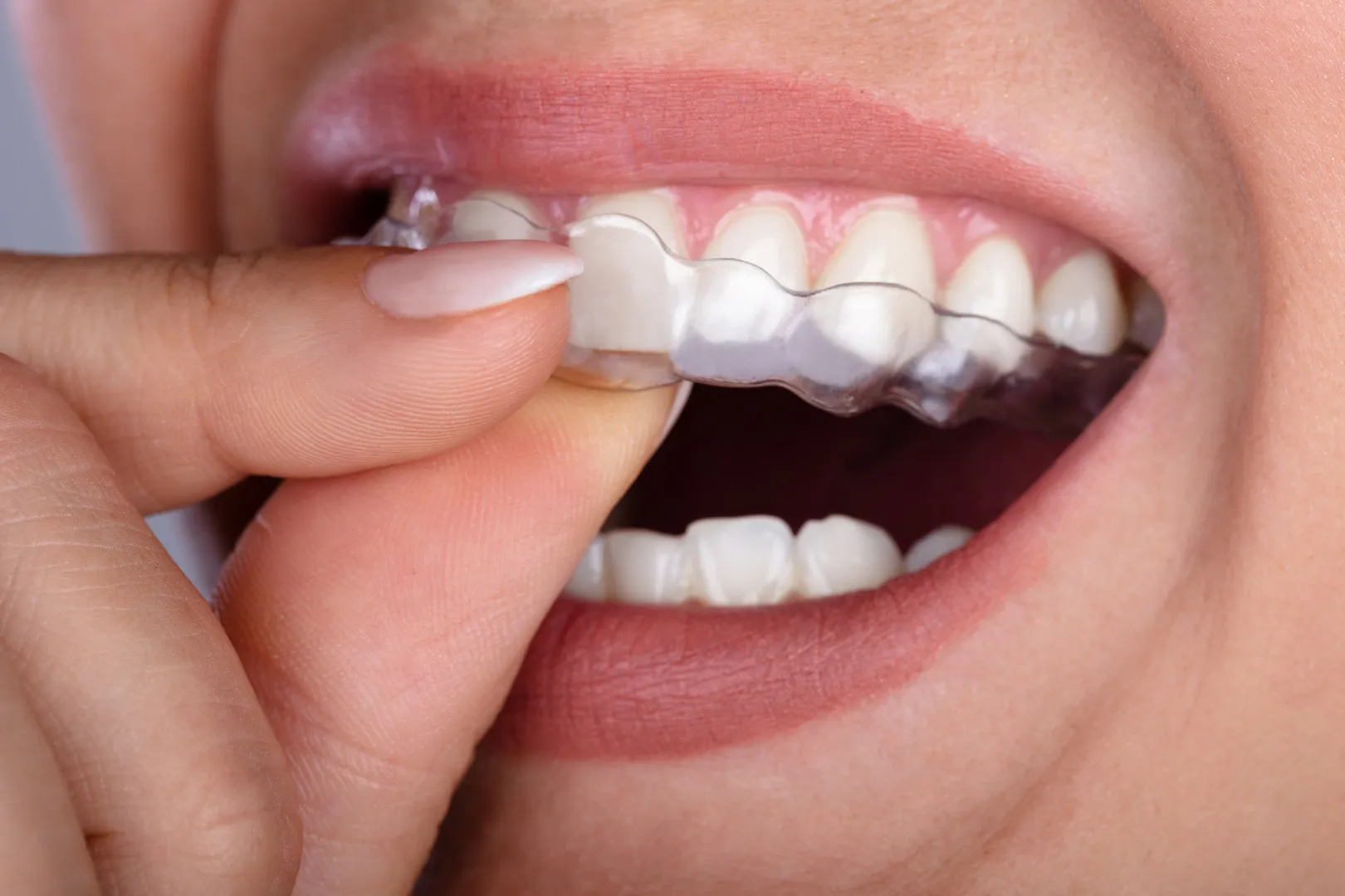 Clear Aligners in Prairieville, LA