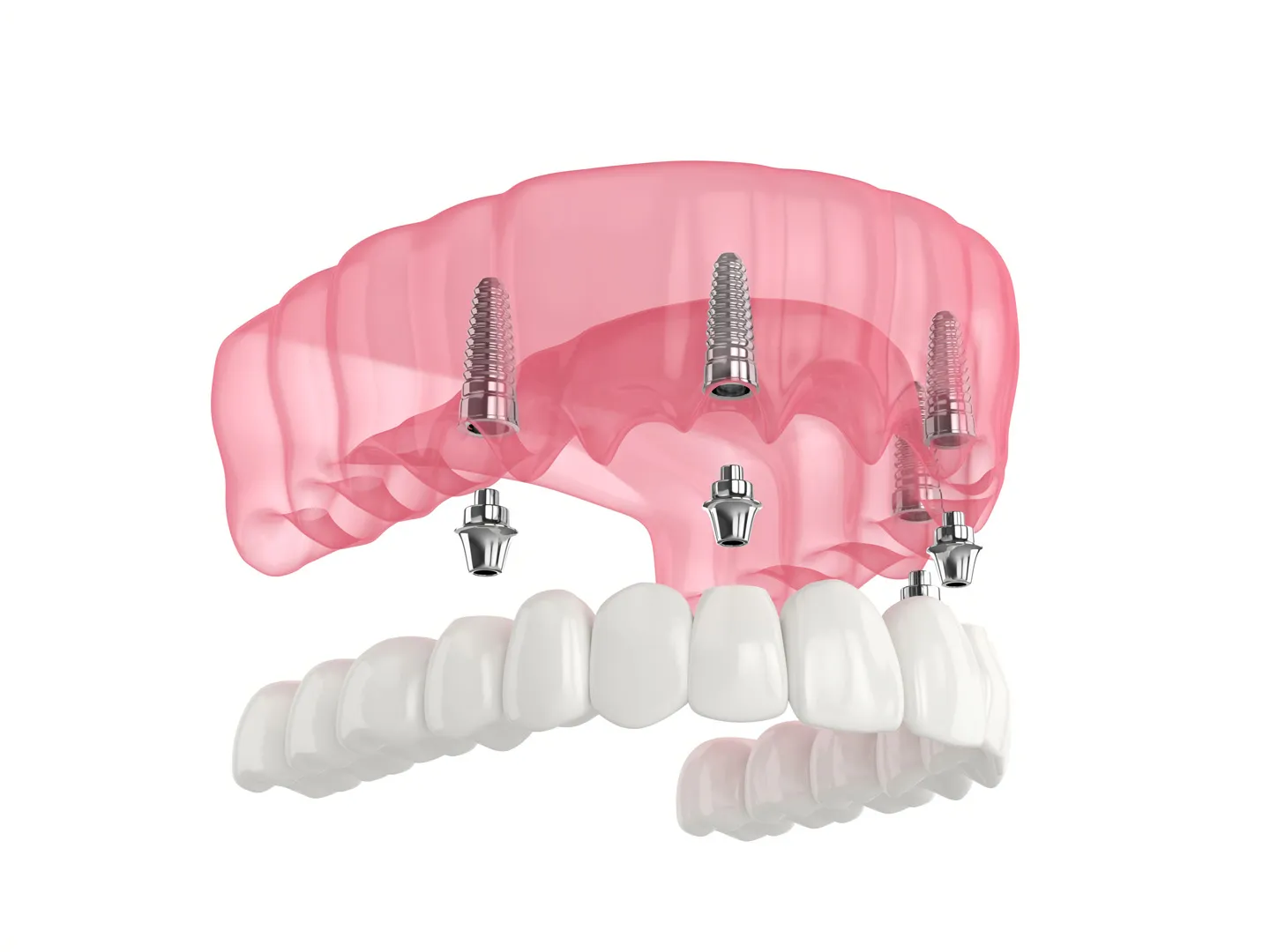 All-On-4 Dental Implants in Prairieville, LA