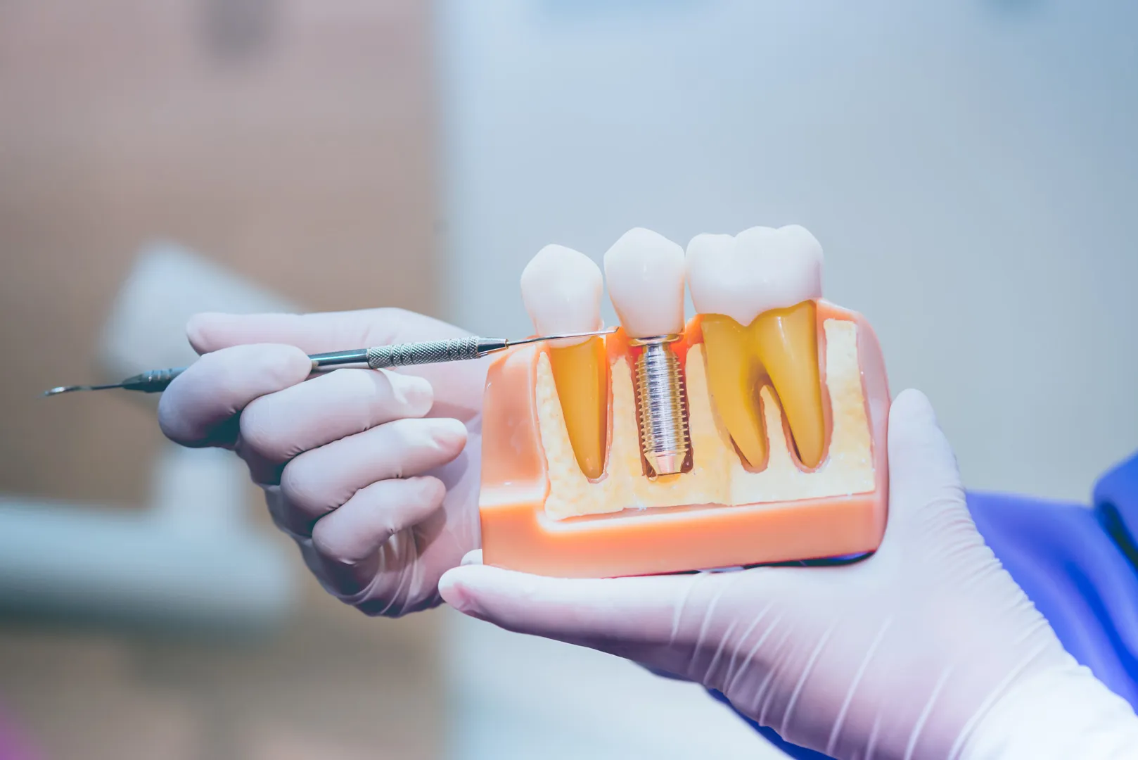 Dental Implants in Prairieville, LA